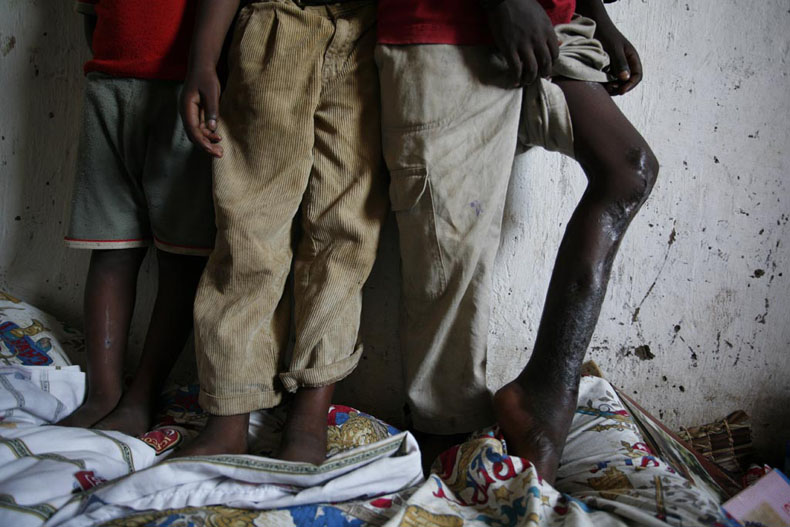 Gatumba survivors, Burundi, March 2007 © Photo by Christophe Calais.