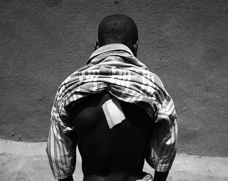 Ouagadougou, avril 09. La violence est quotidienne pour ces enfants. Sam, 14 ans , s'est fait poignardé dans le dos en pleine nuit par un individu, suite à une dispute. © Richard Delaume